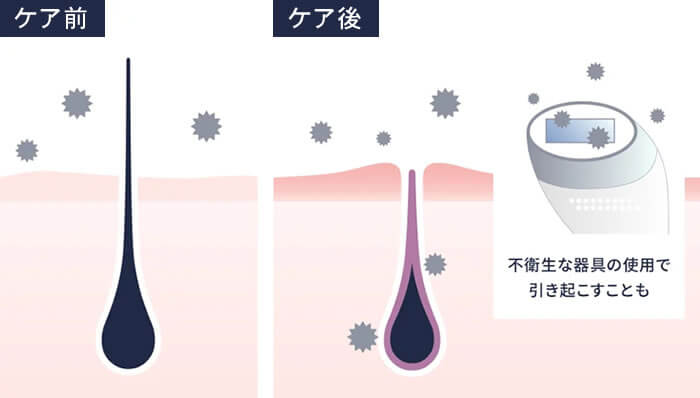 ステラボーテ IPL光美容器